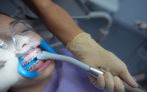 Dentální hygiena odstranění zubního kamene